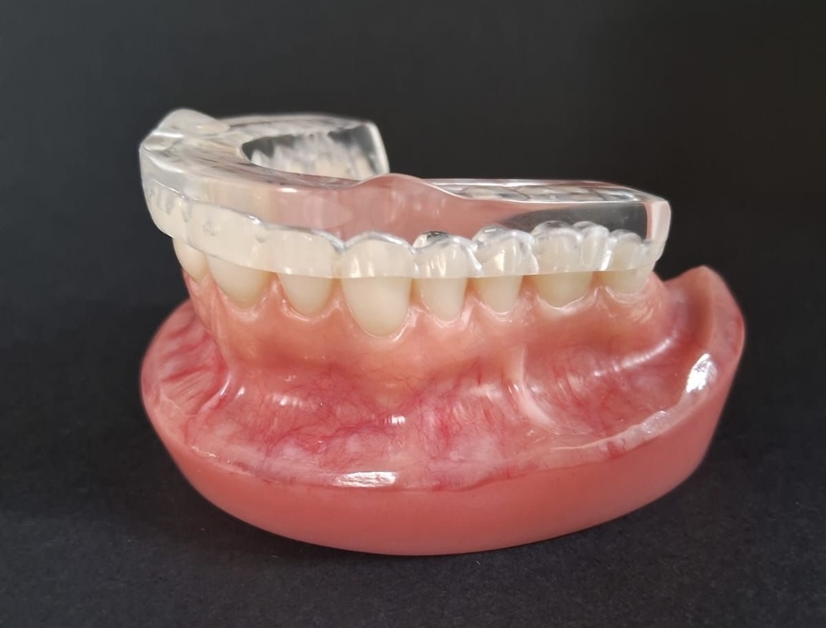Placa oclusal para bruxismo